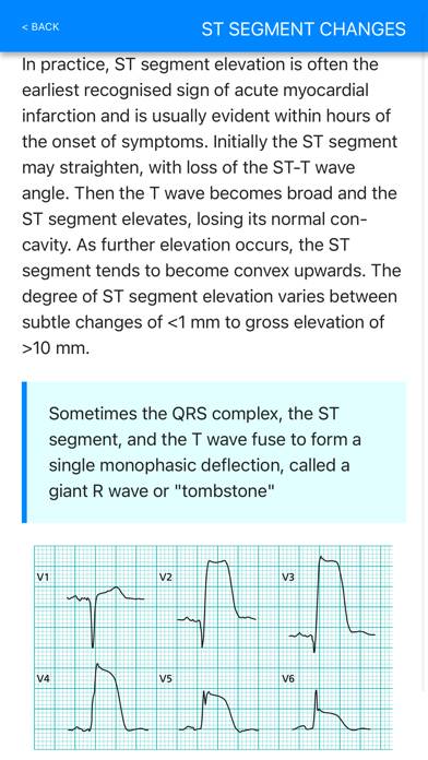 ECG Basics Pro App screenshot #5