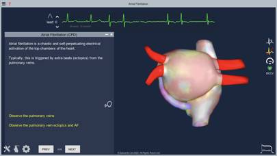 Atrial Fibrillation App screenshot