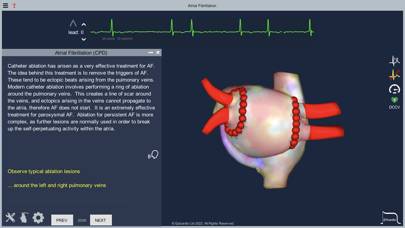 Atrial Fibrillation App screenshot