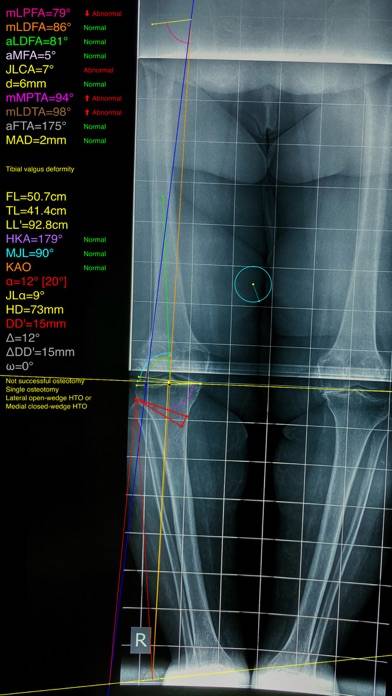 OsteotomyApp Bildschirmfoto