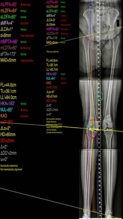 OsteotomyApp Capture d'écran de l'application #2