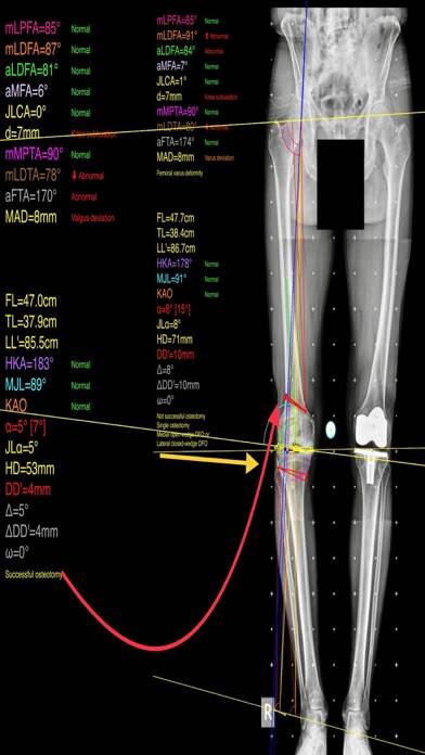 OsteotomyApp Capture d'écran de l'application #3
