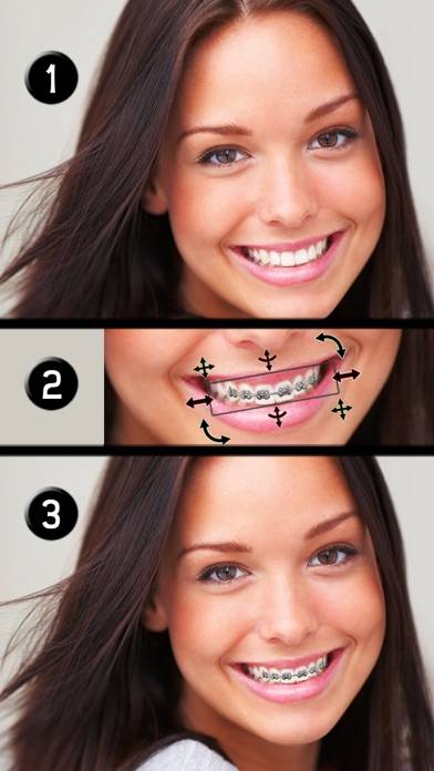 Apparecchio ai denti immagine dello schermo