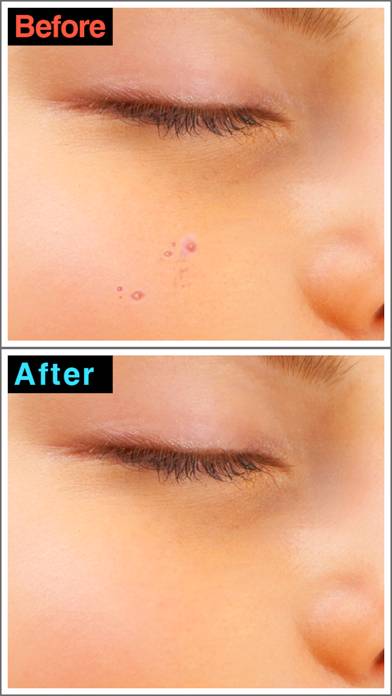 Cool Pimple Eraser plus Captura de pantalla de la aplicación